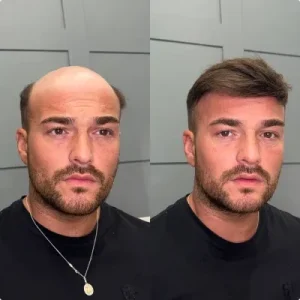 0.06mm Thin skin + Q6 French Lace Front Top/Thin skin Back photo review